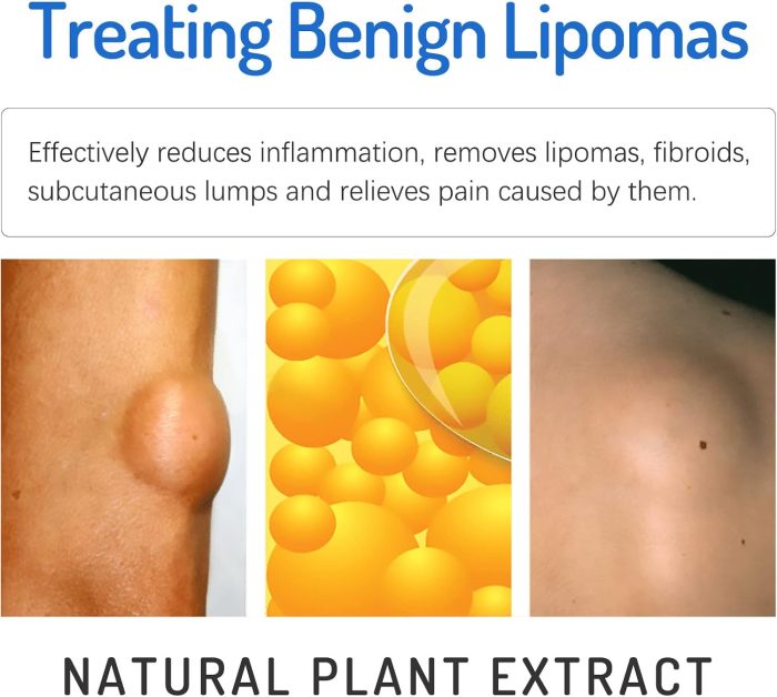 lipoma removal cream