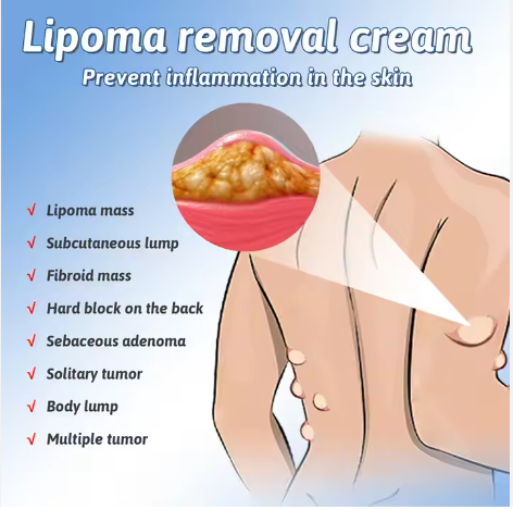 lipoma removal cream