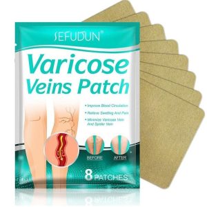 varicose veins how to cure